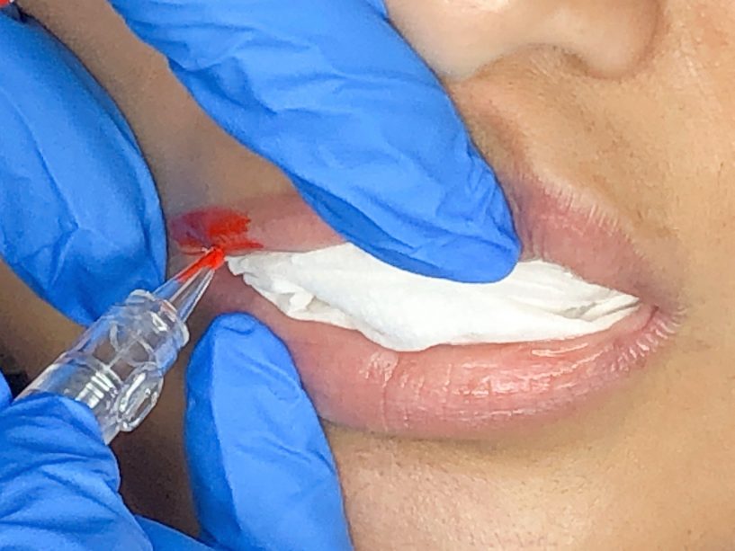 mlfc-lip-tattoo-procedure